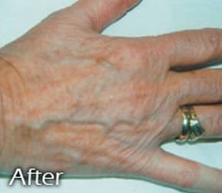 BBL Before and After - Case 4, Image 2 - Female, age  - Flower Mound, TX - Studio 360 Med Spa