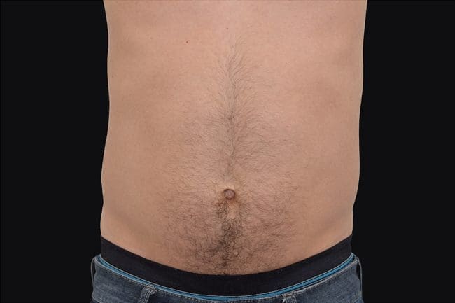 EmSculpt Before and After - Case 5, Image 2 - Male, age  - Flower Mound, TX - Studio 360 Med Spa