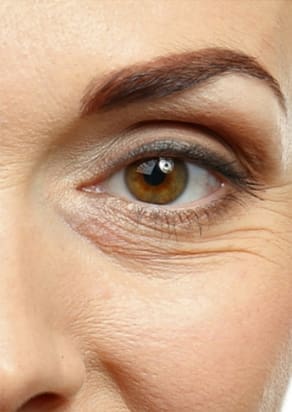 Euro Thread Lifts Before and After - Case 4, Image 1 - Female, age  - Flower Mound, TX - Studio 360 Med Spa