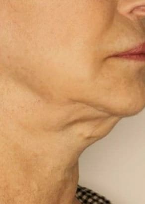 Euro Thread Lifts Before and After - Case 2, Image 1 - Female, age  - Flower Mound, TX - Studio 360 Med Spa