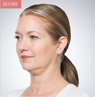 Kybella Before and After - Case -1, Image 1 - Female, age  - Flower Mound, TX - Studio 360 Med Spa