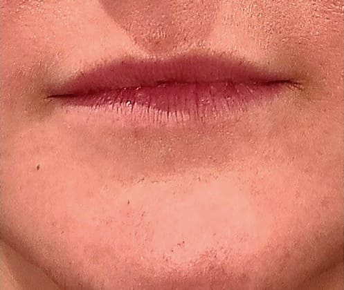 Lip Flip Before and After - Case -1, Image 2 - Female, age  - Flower Mound, TX - Studio 360 Med Spa