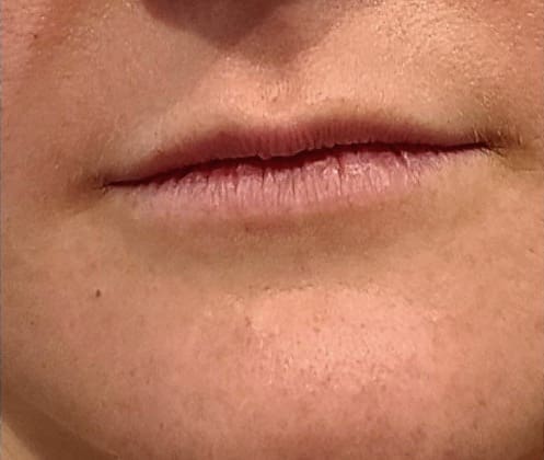 Lip Flip Before and After - Case -1, Image 1 - Female, age  - Flower Mound, TX - Studio 360 Med Spa