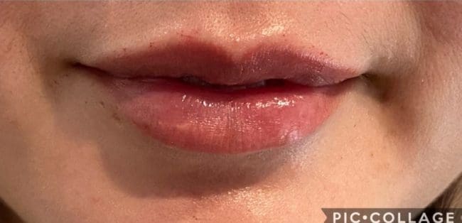 Lip Fillers Before and After - Case -1, Image 4 - Female, age  - Flower Mound, TX - Studio 360 Med Spa