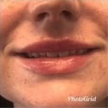 Lip Fillers Before and After - Case 4, Image 4 - Female, age  - Flower Mound, TX - Studio 360 Med Spa
