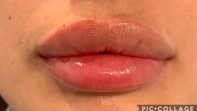 Lip Fillers Before and After - Case 2, Image 2 - Female, age  - Flower Mound, TX - Studio 360 Med Spa