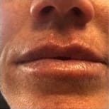 Lip Fillers Before and After - Case 3, Image 2 - Male, age  - Flower Mound, TX - Studio 360 Med Spa