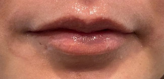 Lip Fillers Before and After - Case -1, Image 3 - Female, age  - Flower Mound, TX - Studio 360 Med Spa