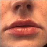 Lip Fillers Before and After - Case 4, Image 3 - Female, age  - Flower Mound, TX - Studio 360 Med Spa