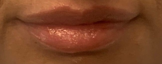 Lip Fillers Before and After - Case 2, Image 1 - Female, age  - Flower Mound, TX - Studio 360 Med Spa
