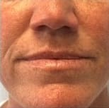 Lip Fillers Before and After - Case 3, Image 1 - Male, age  - Flower Mound, TX - Studio 360 Med Spa