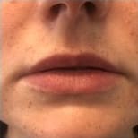 Lip Fillers Before and After - Case 4, Image 1 - Female, age  - Flower Mound, TX - Studio 360 Med Spa