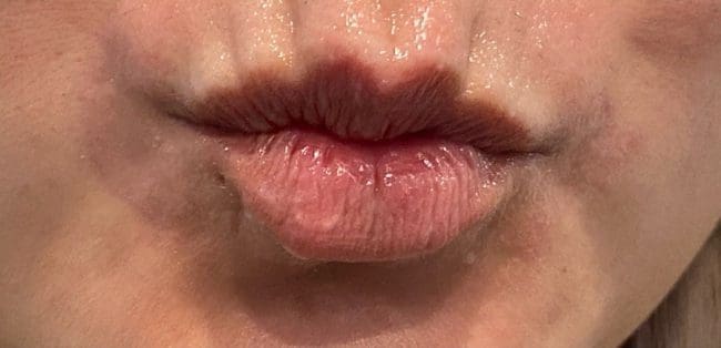 Lip Fillers Before and After - Case -1, Image 1 - Female, age  - Flower Mound, TX - Studio 360 Med Spa