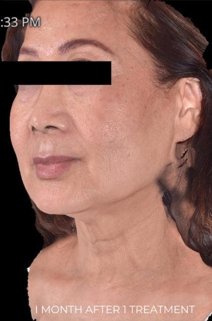 RF Microneedling Before and After - Case -1, Image 2 - Female, age  - Flower Mound, TX - Studio 360 Med Spa
