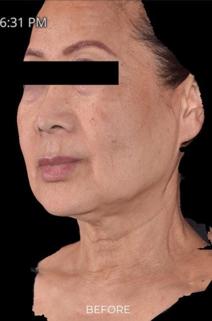 RF Microneedling Before and After - Case -1, Image 1 - Female, age  - Flower Mound, TX - Studio 360 Med Spa