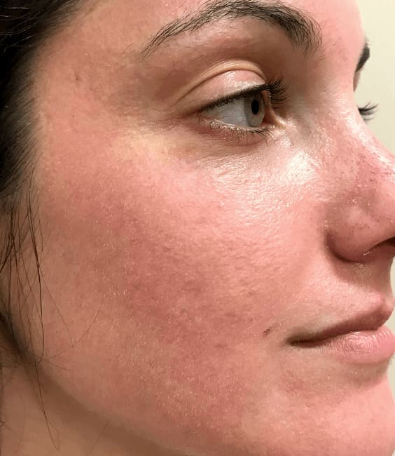 Skin Pen Before and After - Case 2, Image 2 - Female, age  - Flower Mound, TX - Studio 360 Med Spa