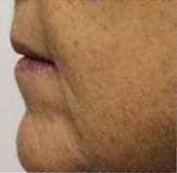 Skin Pen Before and After - Case 3, Image 2 - Female, age  - Flower Mound, TX - Studio 360 Med Spa
