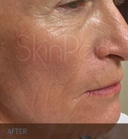 Skin Pen Before and After - Case -1, Image 2 - Male, age  - Flower Mound, TX - Studio 360 Med Spa