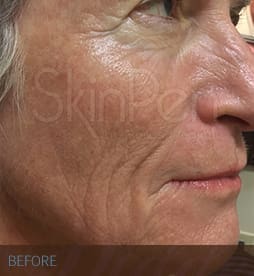 Skin Pen Before and After - Case -1, Image 1 - Male, age  - Flower Mound, TX - Studio 360 Med Spa