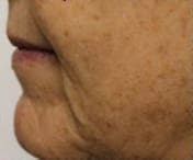 Skin Pen Before and After - Case 3, Image 1 - Female, age  - Flower Mound, TX - Studio 360 Med Spa