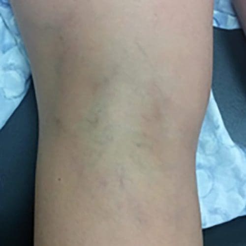 Sclerotherapy Before and After - Case 2, Image 2 - N/A, age  - Flower Mound, TX - Studio 360 Med Spa