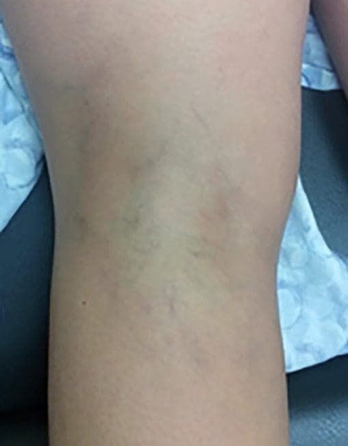 Sclerotherapy Before & Afters | Studio 360 Med Spa