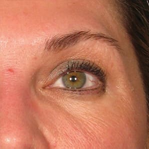 Ultherapy Before and After - Case -1, Image 2 - Female, age  - Flower Mound, TX - Studio 360 Med Spa