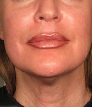 Ultherapy Before and After - Case 2, Image 2 - Female, age  - Flower Mound, TX - Studio 360 Med Spa