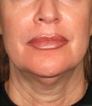Ultherapy Before and After - Case 2, Image 1 - Female, age  - Flower Mound, TX - Studio 360 Med Spa