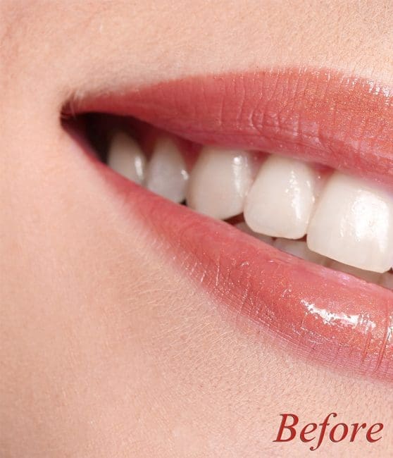 Ultra Teeth Whitening Before and After - Case -1, Image 1 - Female, age  - Flower Mound, TX - Studio 360 Med Spa
