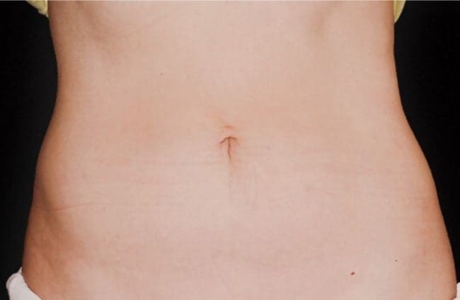CoolSculpting Before and After - Case -1, Image 2 - N/A, age 35 – 44 - Flower Mound, TX - Studio 360 Med Spa