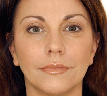 Vampire Facelift Before & Afters | Studio 360 Med Spa
