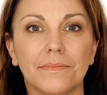 Vampire Facelift Before and After - Case 2, Image 1 - Female, age 45 – 54 - Flower Mound, TX - Studio 360 Med Spa