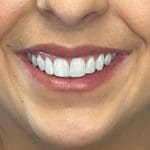 After Botox lip flip procedure